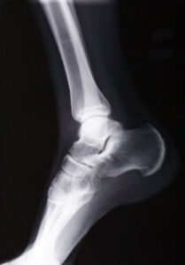 Xray at your location for ankle injury Xray at your location for ankle injury